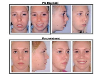 Post-treatment
Pre-treatment
 