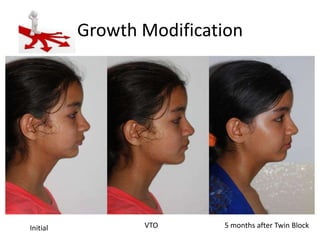 Growth Modification

Initial

VTO

5 months after Twin Block

 