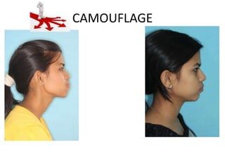 CAMOUFLAGE

 