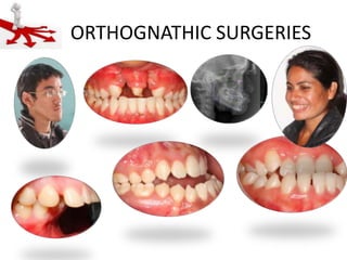 ORTHOGNATHIC SURGERIES

 