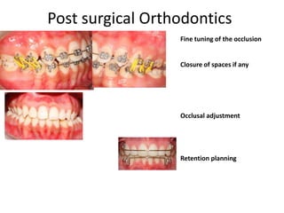 Post surgical Orthodontics
Fine tuning of the occlusion

Closure of spaces if any

Occlusal adjustment

Retention planning

 