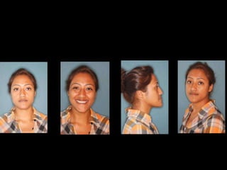 Case 1

23 years old, F
Engineering student, well motivated

Long face
Concave facial profile
Facial asymmetry
Midline deviation

 