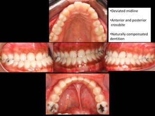•Deviated midline
•Anterior and posterior
crossbite
•Naturally compensated
dentition

 