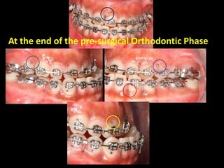 At the end of the pre-surgical Orthodontic Phase

 