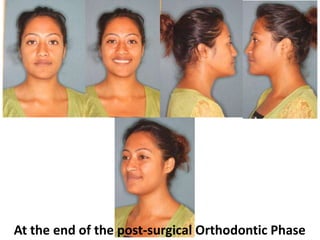 At the end of the post-surgical Orthodontic Phase

 