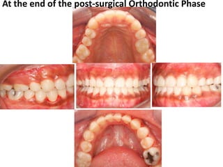 At the end of the post-surgical Orthodontic Phase

 