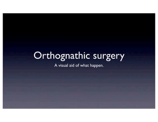 Orthognathic surgery
                              A visual aid of what happen.
                          slideshare.net/sylvainchamberland




©Sylvain Chamberland
 