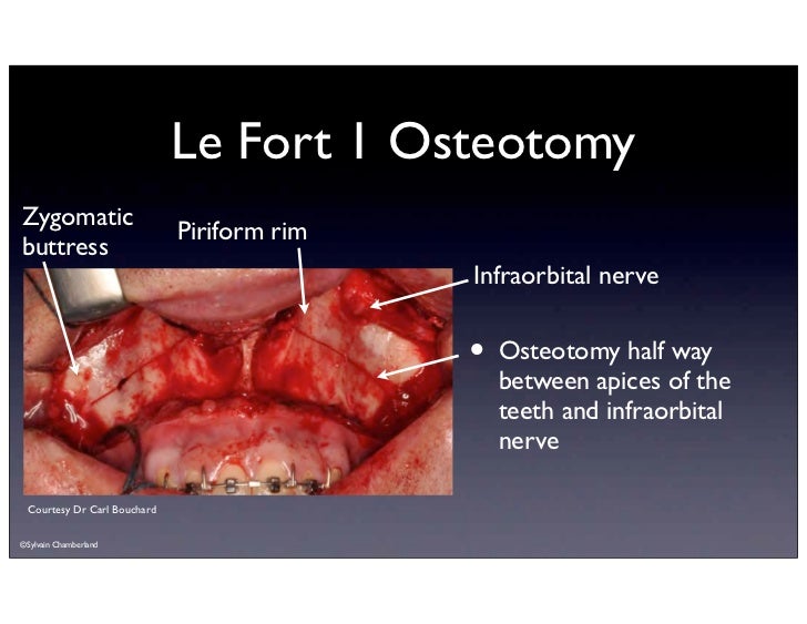 lefort osteotomies