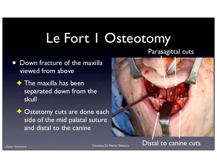 lefort osteotomies
