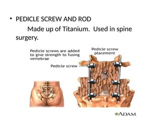 • PEDICLE SCREW AND ROD
Made up of Titanium. Used in spine
surgery.
 