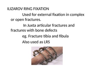 ILIZAROV RING FIXATION
Used for external fixation in complex
or open fractures.
In Juxta articular fractures and
fractures with bone defects
eg. Fracture tibia and fibula
Also used as LRS
 