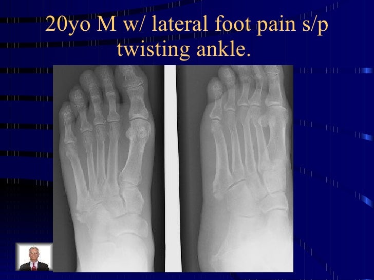 J.J. Watt diagnosed with tibial plateau fracture