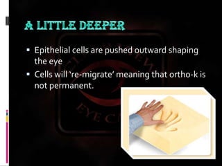 A LITTLE DEEPEREpithelial cells are pushed outward shaping the eyeCells will ‘re-migrate’ meaning that ortho-k is not permanent.