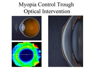 Myopia Control Trough
Optical Intervention
 
