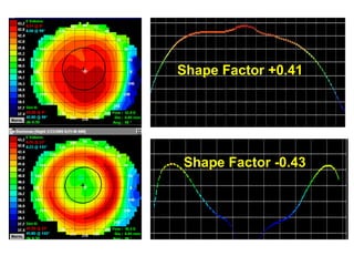 -3.00 D. Change
Shape Factor +0.41
Shape Factor -0.43
 