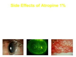 Side Effects of Atropine 1%
Cycloplegia and photophobia
Decreased performance at near
Ultraviolet absorption
Possible macular damage
Papillary & Follicular conjunctivitis
Ocular and Systemic toxicity
Respiratory infection
Fever
 