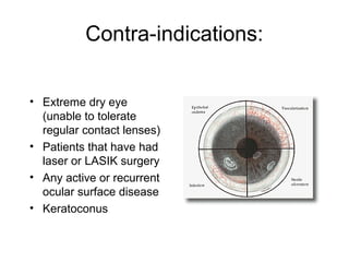 Contra-indications:
• Extreme dry eye
(unable to tolerate
regular contact lenses)
• Patients that have had
laser or LASIK surgery
• Any active or recurrent
ocular surface disease
• Keratoconus
 