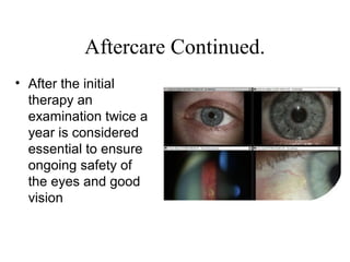 Aftercare Continued.
• After the initial
therapy an
examination twice a
year is considered
essential to ensure
ongoing safety of
the eyes and good
vision
 