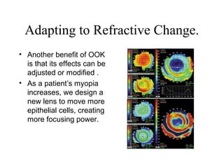 Adapting to Refractive Change.
• Another benefit of OOK
is that its effects can be
adjusted or modified .
• As a patient’s myopia
increases, we design a
new lens to move more
epithelial cells, creating
more focusing power.
 