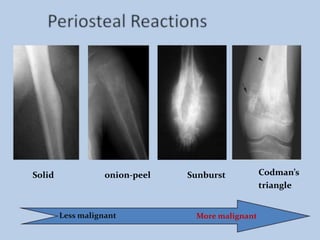 Orthopaedic oncology | PPTX