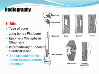 Bone tumors | PPTX