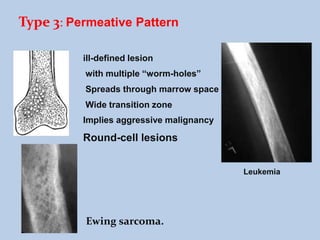 Bone tumors | PPTX