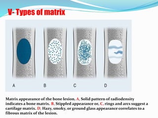 Bone tumors | PPTX