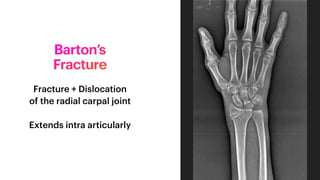 Barton Type Orthopaedics - Distal End Radius fractures.pdf