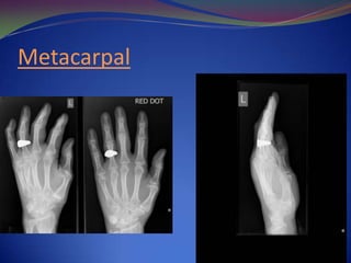 Metacarpian Rx Orthopaedics for the emergency department | PPSX