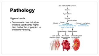 Pathology
Hyperuricemia
• Serum urate concentration
which is significantly higher
than that of the population to
which they belong.
 