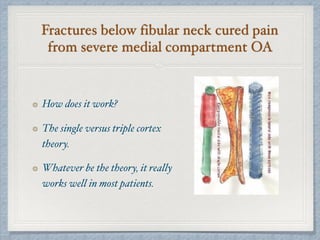 Fractures below fibular neck cured pain
from severe medial compartment OA
How does it work?
The single versus triple cortex
theory.
Whatever be the theory, it really
works well in most patients.
 