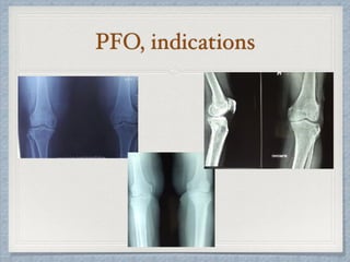 PFO, indications
 