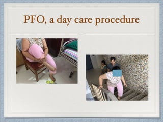 PFO, a day care procedure
 