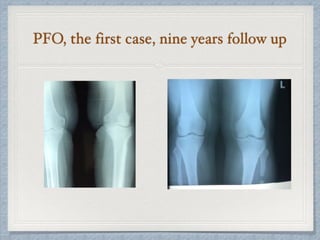 PFO, the first case, nine years follow up
 