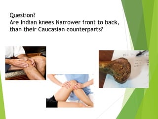 Question? 
Are Indian knees Narrower front to back,
than their Caucasian counterparts?
 