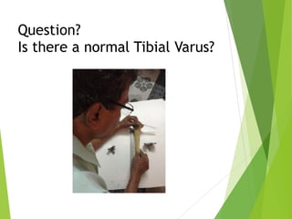 Question? 
Is there a normal Tibial Varus?
 