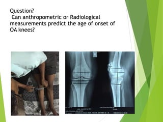 Question? 
Can anthropometric or Radiological
measurements predict the age of onset of
OA knees?
 