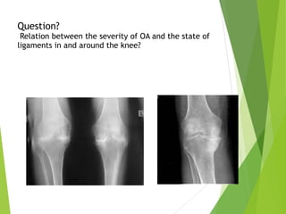Question? 
Relation between the severity of OA and the state of
ligaments in and around the knee? 
 