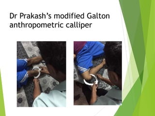 Dr Prakash’s modified Galton
anthropometric calliper
 