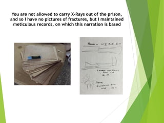You are not allowed to carry X-Rays out of the prison,
and so I have no pictures of fractures, but I maintained
meticulous records, on which this narration is based 
 