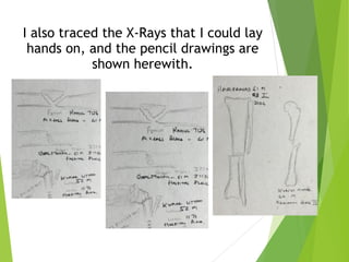 I also traced the X-Rays that I could lay
hands on, and the pencil drawings are
shown herewith.
 