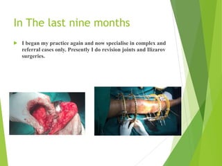 In The last nine months
! I began my practice again and now specialise in complex and
referral cases only. Presently I do revision joints and Ilizarov
surgeries.
 