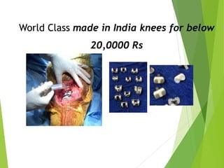 World Class made in India knees for below
20,0000 Rs
 