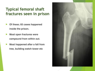 Typical femoral shaft
fractures seen in prison
! Of these; 65 cases happened
inside the prison.
! Most open fractures were
compound from within out.
! Most happened after a fall from
tree, building watch tower etc
 