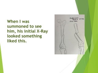 When I was
summoned to see
him, his initial X-Ray
looked something
liked this. 
 