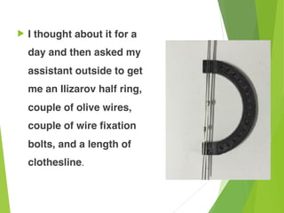 ! I thought about it for a
day and then asked my
assistant outside to get
me an Ilizarov half ring,
couple of olive wires,
couple of wire fixation
bolts, and a length of
clothesline.
 