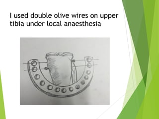 I used double olive wires on upper
tibia under local anaesthesia
 