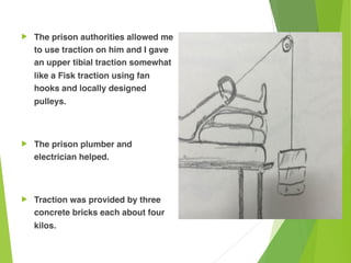 ! The prison authorities allowed me
to use traction on him and I gave
an upper tibial traction somewhat
like a Fisk traction using fan
hooks and locally designed
pulleys.
! The prison plumber and
electrician helped.
! Traction was provided by three
concrete bricks each about four
kilos.
 