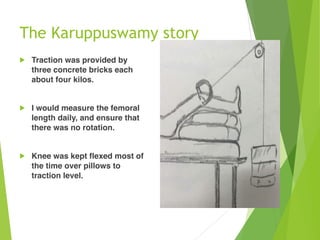 The Karuppuswamy story
! Traction was provided by
three concrete bricks each
about four kilos.
! I would measure the femoral
length daily, and ensure that
there was no rotation.
! Knee was kept flexed most of
the time over pillows to
traction level.
 