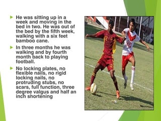 ! He was sitting up in a
week and moving in the
bed in two. He was out of
the bed by the fifth week,
walking with a six feet
bamboo cane.
! In three months he was
walking and by fourth
month back to playing
football.
! No locking plates, no
flexible nails, no rigid
locking nails, no
protruding stubs, no
scars, full function, three
degree valgus and half an
inch shortening
 